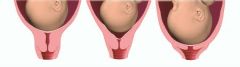This is a subjective measurement indicating the length length left of the cervix. (how thinned out it is)
The typical cervix is 3 to 5 cm in length. Ex: if the cervix feels 2 cm then this about 50% effaced
if there is concern for preterm labor, of...