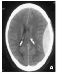 Bloeding tussen dura en schedelbot, wit op CT door haemgroepen, inklemming hersenen, ovaalvormig/biconfex met scherpe rand want endostaal blad scheurt los