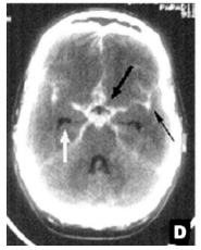 Vaak veroorzaakt door knappen aneurysma, ofwel oppervlakkige arterie. Op CT-scan is cirkel van Willis te zien.