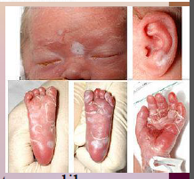 34. Syphilis – Treponema pallidum pallidum.

Can be passed to fetus as it is born resulting in fetal [DEATH] or mental retardation and [MALFORMATION].