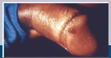 35. Syphilis – Treponema pallidum pallidum.

Primary syphilis – small painless reddened lesion, heals in 3-6 [WEEKS].