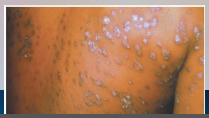 36. Syphilis – Treponema pallidum pallidum.

Secondary syphilis – rash appears 1-6 months _____ exposure and lasts 6-8 weeks.