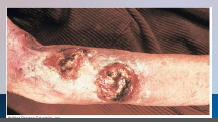 37. Syphilis – Treponema pallidum pallidum.

Tertiary syphilis – appears 1-10 [YEARS], gummas, soft, tumor-like growths that can occur anywhere including on skeleton, cardiovascular and neurological symptoms that can lead to [DEATH].