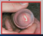 41. Gonorrhea – Neisseria gonorrhoeae.

Symptoms in Men.

[PURULENT] discharge (aka. gleet).