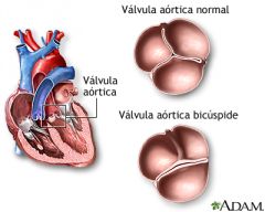 Válvula que protege la base de la arteria aorta que sale del ventrículo izquierdo.