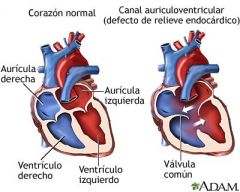Anomalía del corazón debida a válvulas defectuosas. Producen sonidos cardiacos anormales.