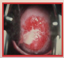47. Gonorrhea – Neisseria gonorrhoeae.

Symptoms in Women.

Attaches to [CERVIX], uterus and fallopian tubes.