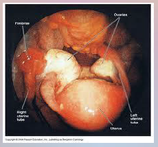 48. Gonorrhea – Neisseria gonorrhoeae.

Symptoms in Women.

Leads to PID (pelvic ____________ disease).