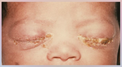 49. Gonorrhea – Neisseria gonorrhoeae.

Symptoms in Newborns (infected during delivery) – inflammation of cornea and conjunctiva leading to [BLINDNESS].
