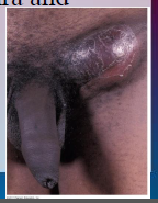 53. Chlamydia – Chlamydia trachomatis.

Lymphogranuloma venereum.

Stage 3 – (few cases) genital sores, constriction of urethra and genital [ELEPHANTIASIS], arthritis.