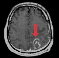 Case 1:
- 29 yo male recently diagnosed w/ HIV presents to ED w/ seizures
- HIV viral load is 72,300 copies/mL and CD4+ count is 75
- History of DM, hyperlipidemia, chronic hepatitis B infection

He gets an MRI as shown

Which of the follow...