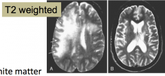 MRI shows T2 bright white matter changes usually WITHOUT ENHANCEMENT OR MASS EFFECT