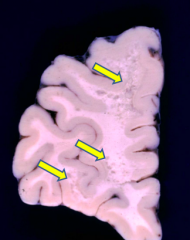 Small foci of gray discoloration in the white matter