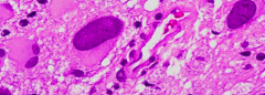 Progressive Multifocal Leukoencephalopathy (PML)
- Bizarre astrocytes