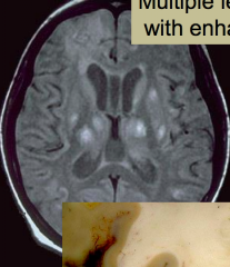 Toxoplasma encephalitis
- Multiple lesions with enhancement