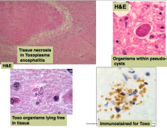 - Tissue necrosis
- Organisms within pseudocysts
- Toxo organisms may lie free in tissue
- Immunostain for Toxo (brown)