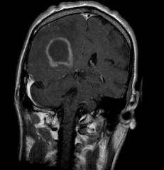 Often MULTIPLE lesions in a periventricular location with contrast enhancement and mass effect