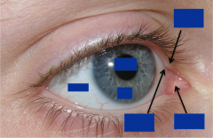 Surface anatomy of eye: 




-Sclera


-Cornea


-Pupil


-Iris


-Eyelashes


-Lacrimal caruncle


-Superior lacrimal papilla


-Inferior lacrimal papilla


-Lacrimal puncta (opening) 