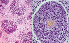 Perivascular arrangement of neoplastic cells