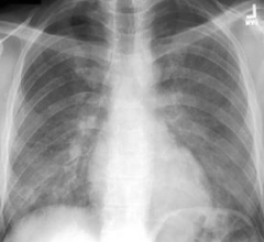 Diffuse interstitial infiltrates