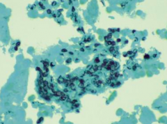 GMS stain
- Numerous, intraalveolar, boat-shaped and crescentic cyst forms of Pneumocystis