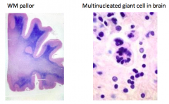 - White matter pallor
- Multinucleated giant cells in brain