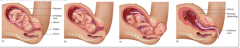 71. Labor starts due to hormonal changes in the mother and possibly the fetus.

______ dilates