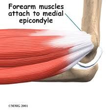 INFLAMMATION of the common flexor tendon near its origin at THE medial epicondlye