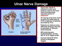 Clawed hand 
Thumb is fine, cannot adduct, can flex pointer and middle, lost ability to abduct and adduct the digits, test this by holding a credit card between their fingers 
Can be caused by cyclists, compressing against the handle bars
