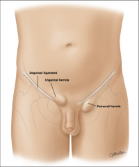 inguinal is above the penis 
 
femoral is to the pt's left of the penis
