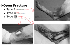 Type 1- open spot is less than 1cm in size, treat like a closed fracture


Type 2- open spot is greater than 1cm. You can treat like an open or closed fracture depending on the tissue


Type 3- You have major tissue loss, the fragment may have als...