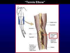 Radial nerve entrapment – deep branch that does all extensors of the forearm 
 - hard to extend the wrist, also impacts grip because the tendons for gripping/shaking someones hand more efficient when your hand is extended than flexed 

Tennis...