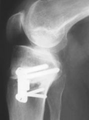 high tibial osteotomies, especially opening wedge osteotomies. This procedure raises the tibiofemoral joint line and can cause retropatellar scarring and tendon contracture, decreasing the distance of the patellar tendon from the inferior joint li...