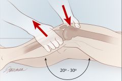 assesses stability of the ACL - slightly more accurate than drawer test

pt supine
you grasp distal tibia w/1 hand
grasp distal femur with the other
flex knee to 30 degrees
pull tibia forward
compare to other side

+ if tibia excessively ...