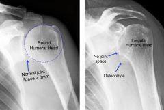 Full-thickness supraspinatus tears have been historically rare in patients with primary shoulder osteoarthritis, with most studies showing a rate of < 10%, asymptomatic pts w/prevelance of rotator cuff tears (30-55%) in individuals over the age of...