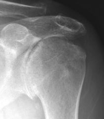 Inflammatory arthritis (e.g. JRA, RA) of the shoulder characteristically demonstrates concentric glenoid erosion w/ medialization of the glenohumeral jnt. Subchondral sclerosis is seen in OA w/ periarticular osteopenia is seen in inflammatory arth...