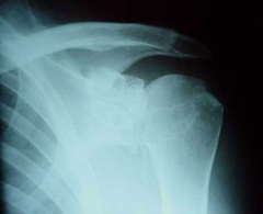 Hx:72yo c/o progressive pain, restriction of motion in L shoulder. PE= active & passive motion are restricted to 90 deg of forward elevation & neutral external rotation. xray Fig A & PE, where is glenoid wear most likely to exist? 1-Anterior; 2-Po...