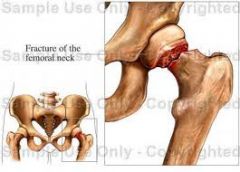 Doesn't that fracture of the femoral neck look darn painful ?! Yeah, this kind of fracture -- an intracapsular fracture--threatens the entire blood supply to the head of the femur (remember, how the branch of the medial circumflex artery)