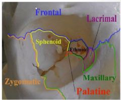 frontal - upper eyebrow 
zygomatic - side 
maxilla - underneath + floor 
side - lacrimal/ethmoid/palatine 

Sphenoid - back 