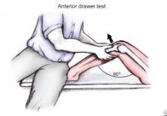 test for stability of the ACL 
1. patient is supine, hips flexed to 90 degrees and feet flat on the table, cup your hands around the knee with the thumbs on the medial and lateral joint line and the fingers on the medial and lateral insertions of ...