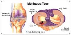 meniscus: cushioning associated with ligaments 
 
injuries usually caused by sudden rotation in extreme flexion or or extension with crush of meniscus between condyles