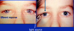 Abnormality of the swinging light test producing a large pupil. It is an afferent abnormality. 