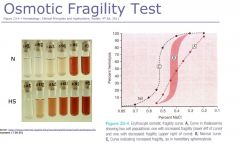 Osmotic Fragility Test
A. thalassemia
B. normal
C. spherocytes present or fragility -->  proceed to Flow Cytometry and Sprectrin immunoassay