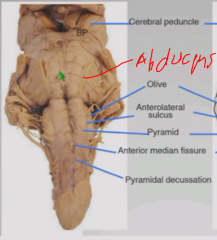 Pyramids
Base of pons with basilar artery
Pyramidal decussation
Abducens nerve
