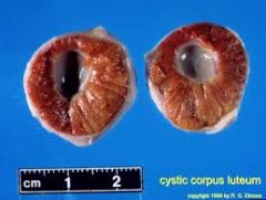 What are luteinised cysts?