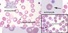 - NO SPHEROCYTOSIS
- Anisocytosis
- Macrocytosis
- Polychromasia
-  Echinocytes and acanthocytes