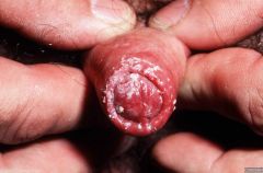 Penishoved svamp på Symptomer på