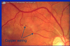 Hypertensive retinopathy
