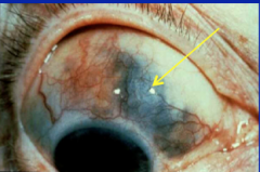 Scleritis/episcleritis = deep inflammation of the sclera and the vessels. Begins with red, inflamed sclera and later may cause scleral thinning with ability to see urea. causes include:
- rhematoid arthritis
- vasculitis
