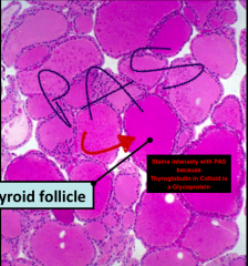 Notice how the colloid is really intensly stained and uniformAlso note that there are capillaries between adjacent follicles (like where the S is ending)